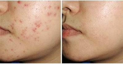 1 lon bia - 4 công thức trị sạch các loại mụn trên da