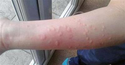 3 cách chữa mề đay, mẩn ngứa được các mẹ săn lùng