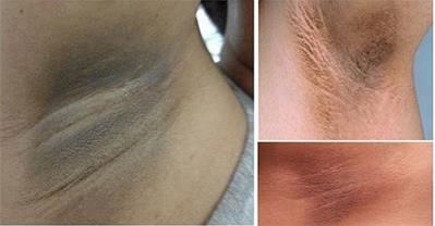 4 cách làm vùng da dưới cánh tay trở nên trắng mịn