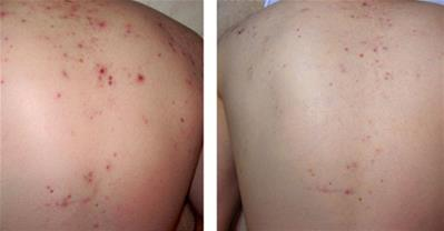 4 cách trị mụn ở lưng siêu hiệu quả chưa đến 10k