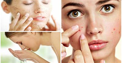 7 cách chăm sóc da mụn mùa đông mà chị em cần phải biết
