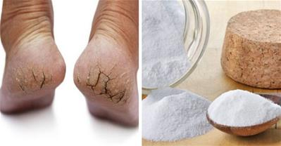 Bí kíp trị nứt gót chân sau 1 đêm không cần dùng thuốc