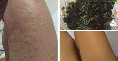 Cách chữa bệnh mề đay, mẩn ngứa khỏi ngay sau 5 phút