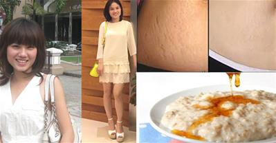 Cách chữa rạn da tiết kiệm cả chục triệu đi thẩm mỹ