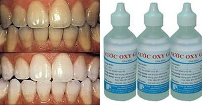 Cách làm trắng răng cấp tốc từ oxy già cực hiệu quả