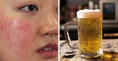 Cách trị mụn cực hiệu quả từ bia mà không cần nặn