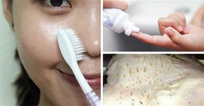 Cách trị mụn đầu đen chỉ với chiếc bàn chải đánh răng