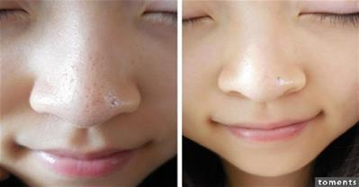 Cách trị mụn đầu đen trong tích tắc cực dễ