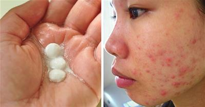 Cách trị mụn làm mờ sẹo với thuốc aspirin cực hiệu quả