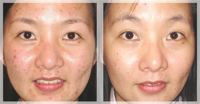 Cách trị mụn nhanh chóng chỉ trong đúng 4 ngày