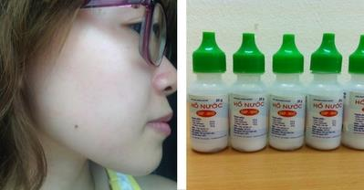 Cách trị mụn từ hồ nước giá 5k sau 1 tháng của Linh Nga