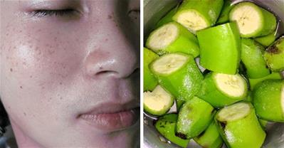 Cách trị tàn nhang làm trắng da từ quả chuối xanh