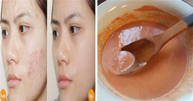 Cách trị thâm mụn sau 1 tuần từ mặt nạ cà rốt giá 10k