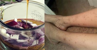 Cách trị vết thâm do sẹo hiệu quả chỉ với 1 nốt nhạc