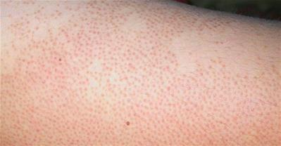 Cách trị viêm lỗ chân lông bằng nguyên liệu đơn giản