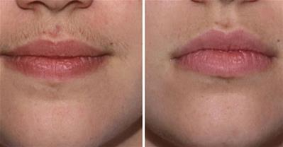 Cách triệt ria mép cực hiệu quả không tốn kém