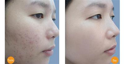Em đã trị mụn và thâm thành công trong 2 tháng cả nhà ạ