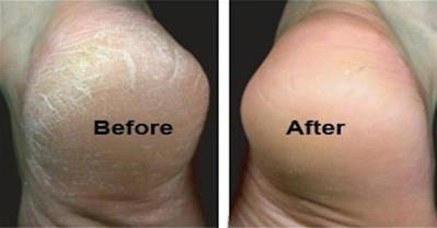 Gót chân nứt nẻ sẽ khỏi ngay lập tức với 1 quả chuối