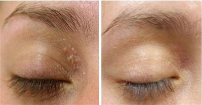 Hết ngay mụn thịt  chỉ với 1 củ tỏi, không gây bỏng rát