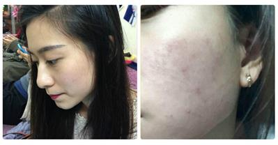 Học lỏm cách trị mụn, làm đẹp nhờ thuốc bắc tại các spa