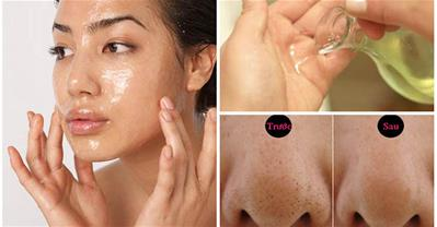 Mách bạn cách lấy mụn đầu đen không làm to lỗ chân lông