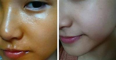 Mặt chi chít mụn thâm trở nên trắng bóc chỉ sau 3 tuần