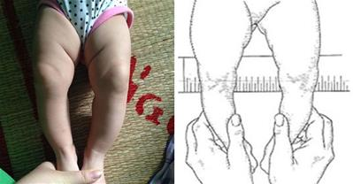 Mẹo giúp bé hết chân vòng kiềng đi đẹp như người mẫu