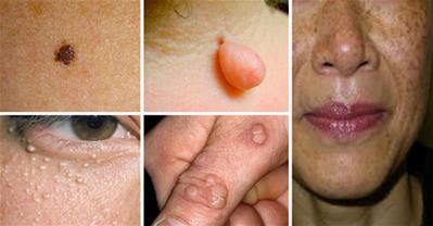 Mẹo làm đẹp loại bỏ mụn thịt, mụn cóc dễ dàng