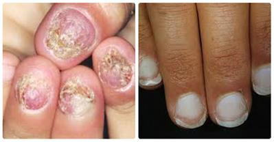 Những dấu hiệu của móng tay cảnh báo bạn đang bị bệnh