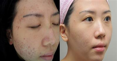 Những địa chỉ chữa mụn trứng cá tốt nhất cả nước