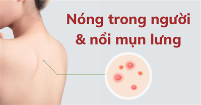 Nóng trong người và nổi mụn lưng phải làm sao? Thanh lọc cơ thể