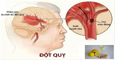 Phòng tránh đau tim, đột quỵ nhờ loại nước uống thần kì