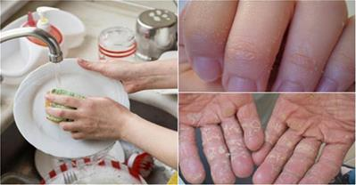 Rửa bát không lo bị bong tróc da tay với công thức này