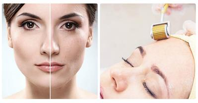Thực hư tác dụng làm đẹp bằng lăn kim, các cơ sở uy tín
