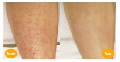 Trị khỏi viêm nang lông với những nguyên liệu tại nhà