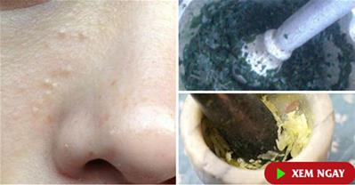 Trị mụn thịt tận gốc chỉ với tỏi và nắm lá tía tô