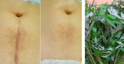 Trị sẹo lồi bằng nắm lá ngải cứu giá 5k sau 3 tuần
