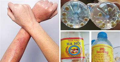 Trị viêm lỗ chân lông bằng thuốc giảm đau aspirin
